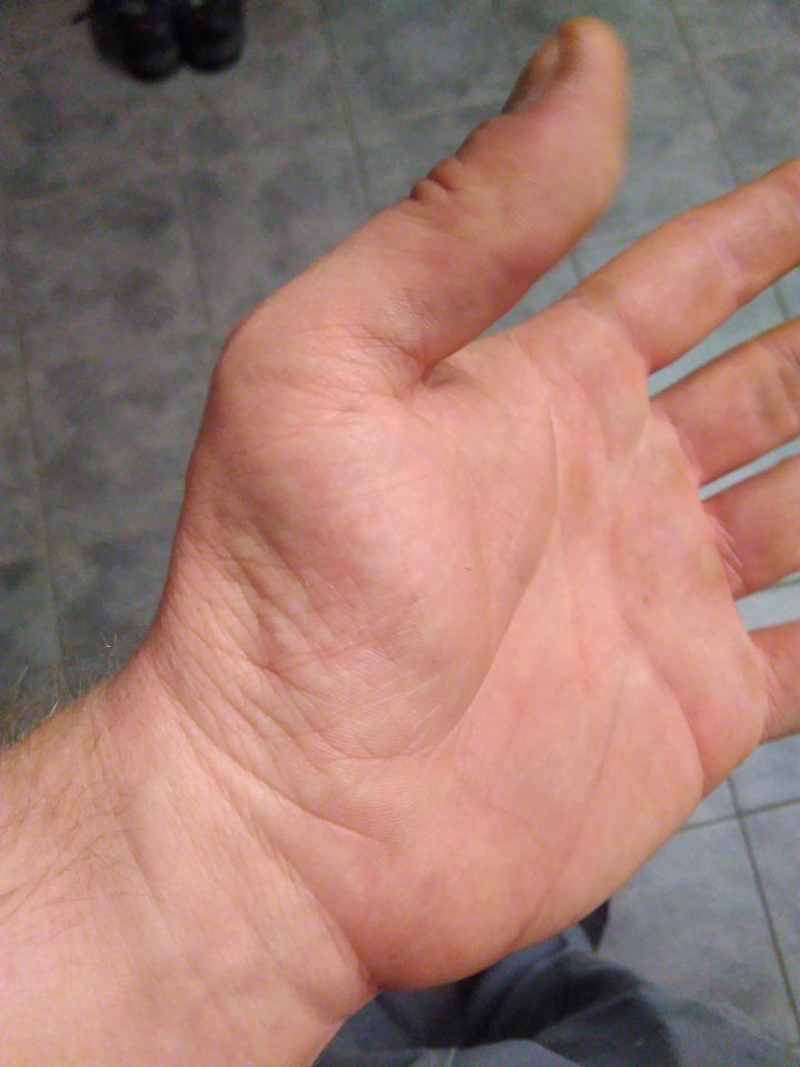 Karpaltunnelsyndrom linke Hand