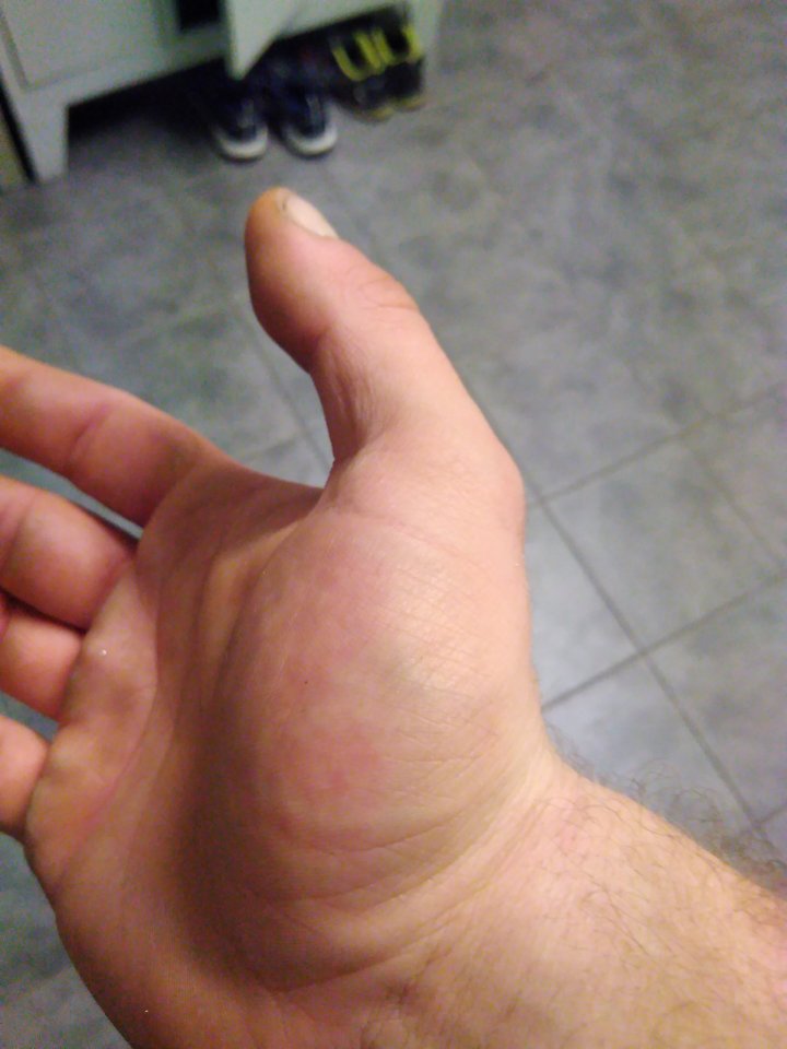 Karpaltunnelsyndrom rechte Hand