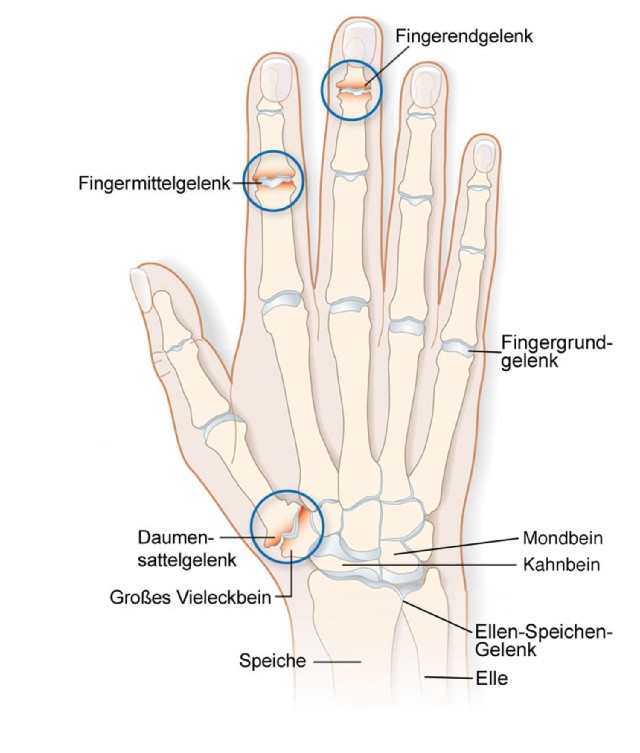 Fingergrundgelenk.jpg