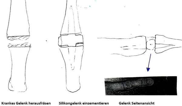 Kleinfinger-Silikongelenk kl.jpg