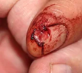 Finger vorher.webp Finger vorher.webp