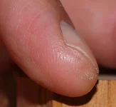 Finger nachher.webp Finger nachher.webp
