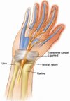 carpal_tunnel_syndrome.jpg